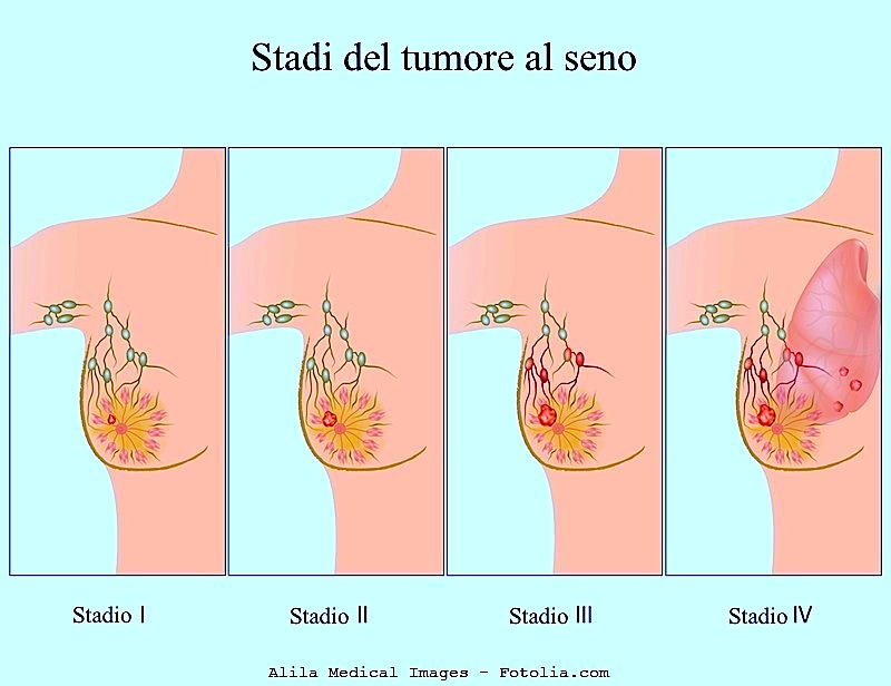 Cancer en la sangre tiene cura